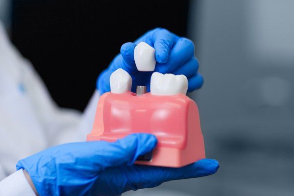 Tooth Colored Fillings - Christiana Pleasant Dental