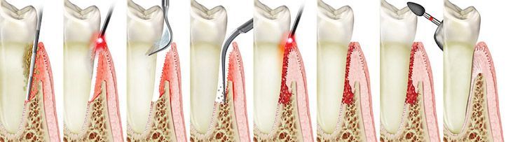 A row of teeth with different stages of tooth decay.