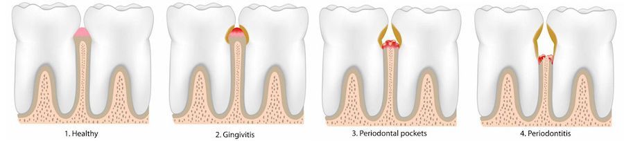 A diagram of a tooth with a hole in it.
