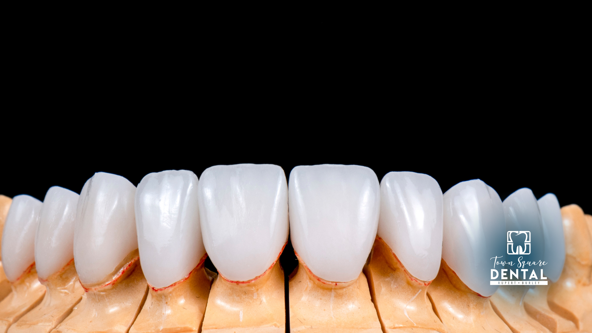 Close-up of white dental veneers on a row of teeth against a black background