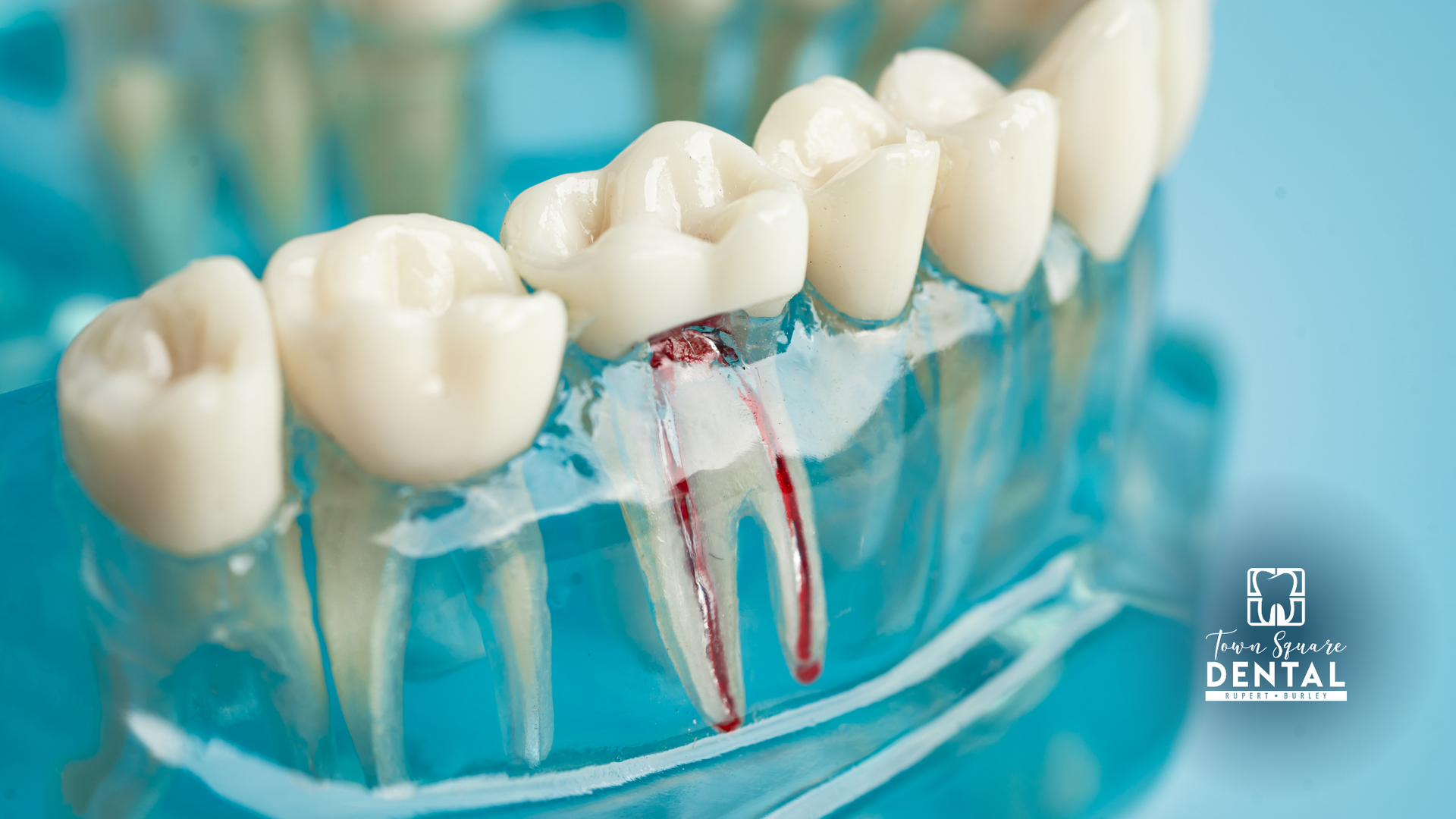A model of a tooth with a root canal in it.