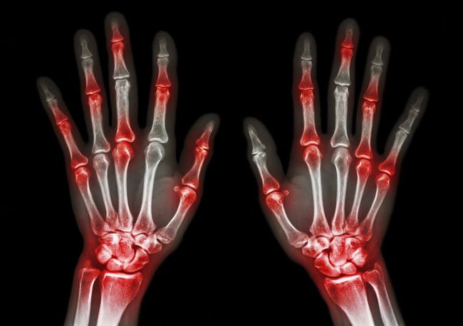 Radiografía de manos con resaltado rojo en las articulaciones, indicativo de artritis.