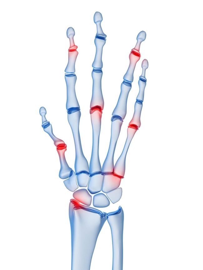 Ilustración del esqueleto de la mano, los reflejos rojos indican áreas de inflamación, potencialmente artritis.