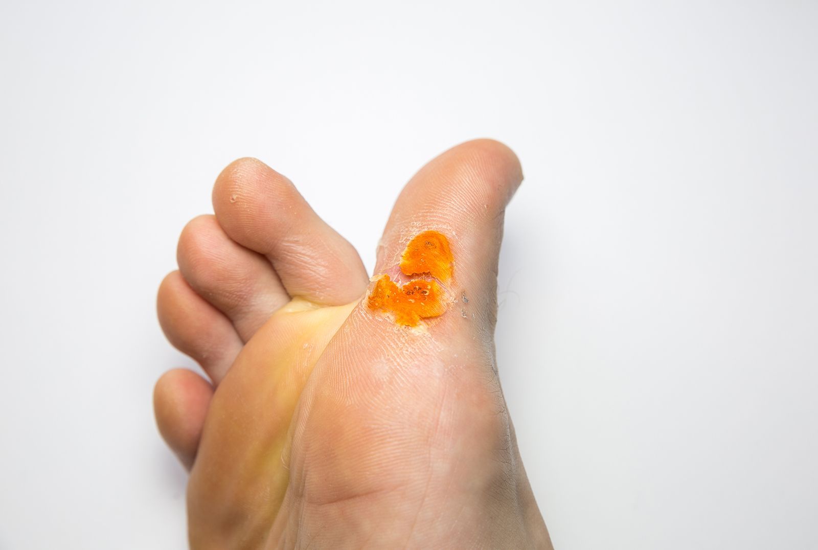 Pie con una ampolla en el metatarso. La ampolla es naranja y contrasta con la piel pálida del pie.