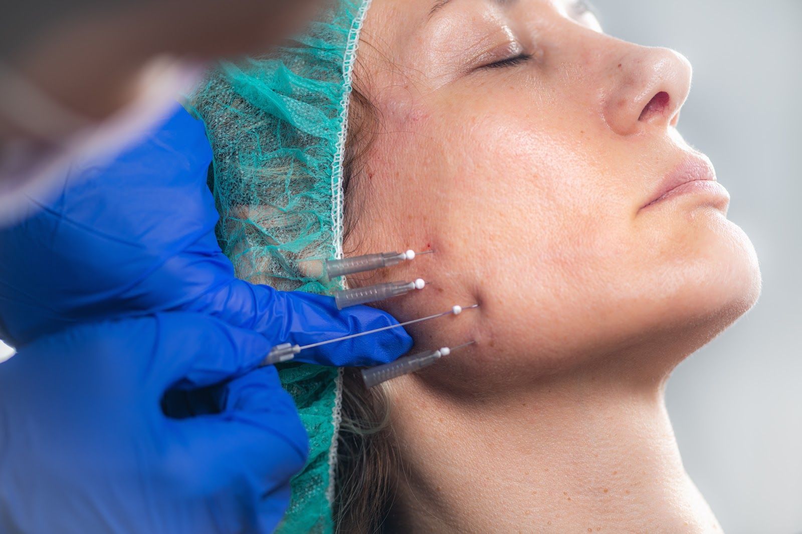 Gloved hand injecting a woman’s cheek with cosmetic filler in a clinic
