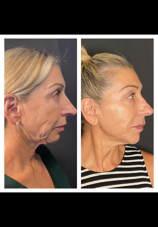 Side-by-side profile photos showing a woman’s face before and after cosmetic treatment.