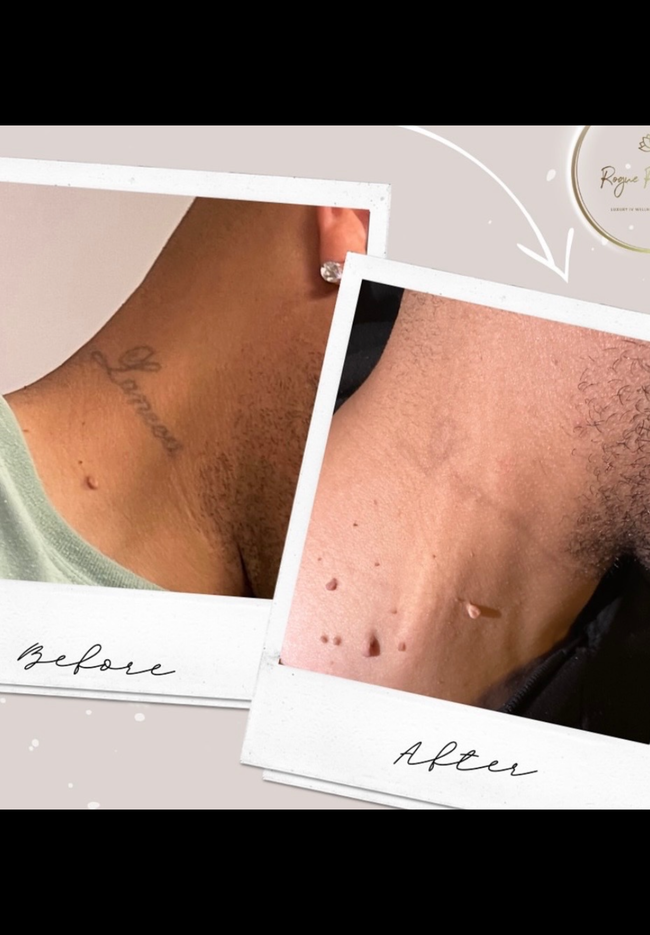 Before and after photos of neck skin showing fading dark marks and bumps.