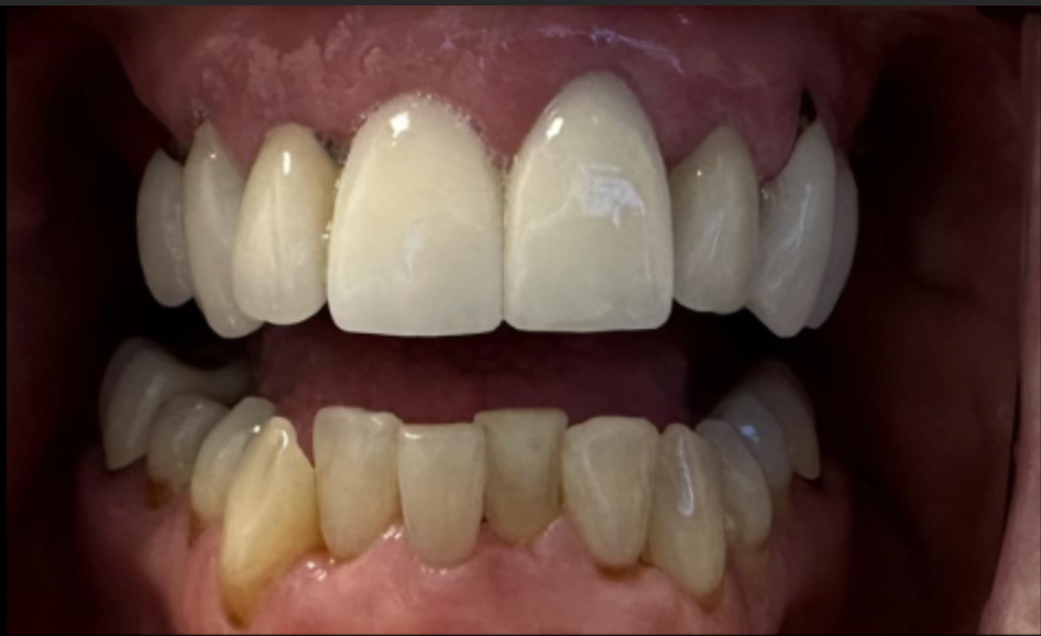 Close-up of teeth; top row bright white, bottom row yellowed, visible tongue.