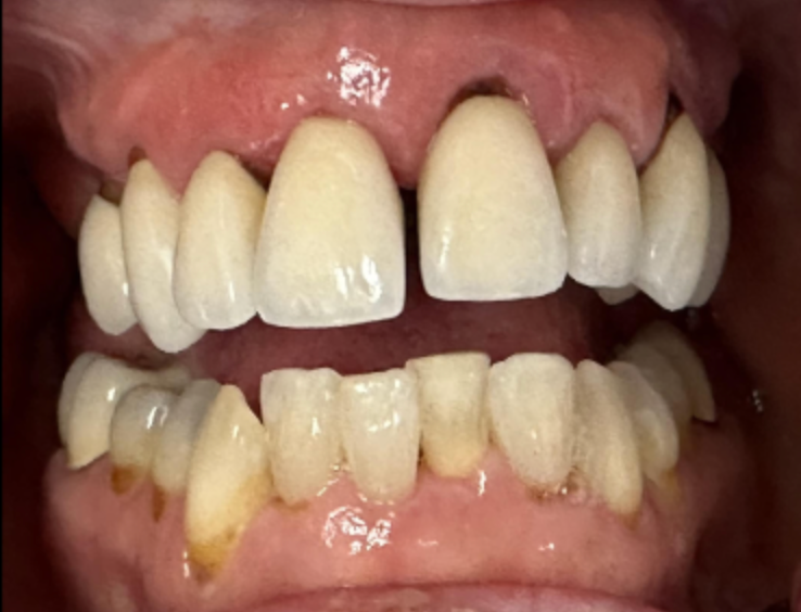 Close-up of a person's teeth, showing a gap between the front teeth, some yellowing, and visible gums.