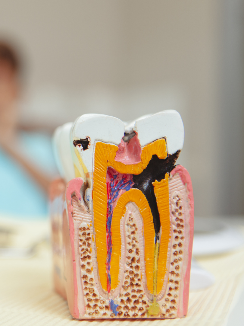 Tooth model with cavity, showing inner structure and decay.