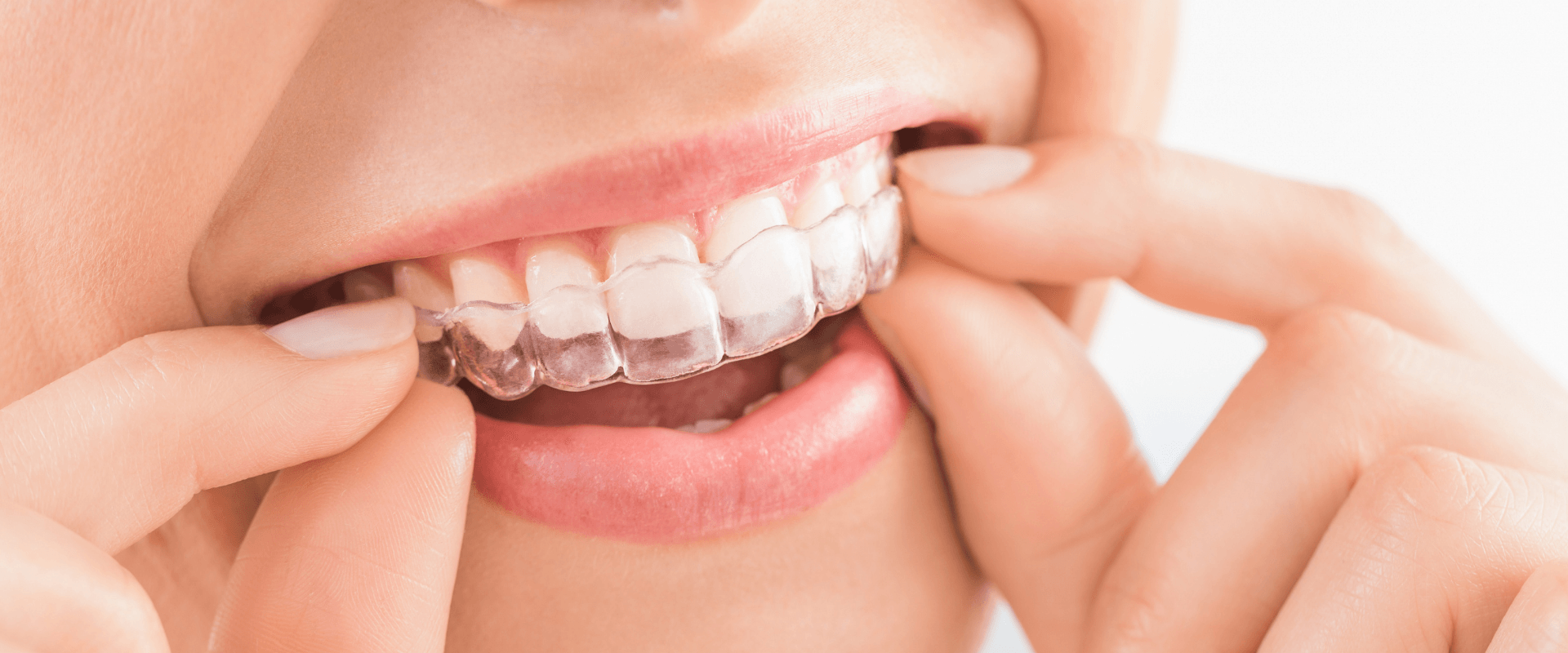 Person's mouth with clear aligners being put in or taken out.