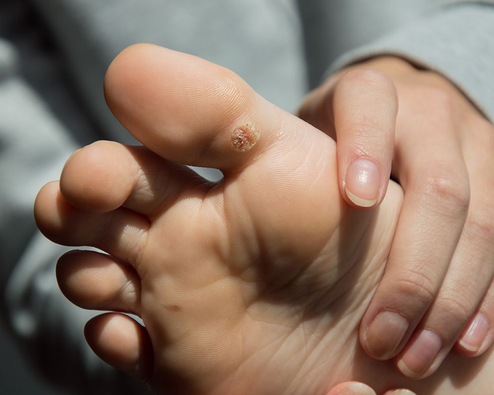 Plantar Wart