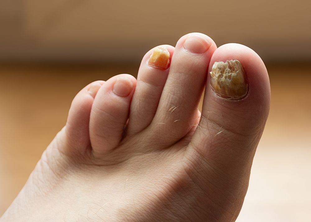 Nail Fungus