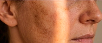 Close-up de um rosto com a pele com melasma e opaca com uma faixa de luz vertical brilhante refletindo na bochecha e nariz.