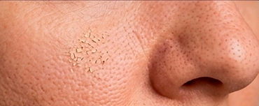 Imagem em close-up do nariz e da bochecha, mostrando poros visíveis e textura da pele.