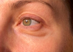 Close-up de um olho verde com olhar calmo e inchado com bolsas de pele, rodeado por pele e cabelo castanho.