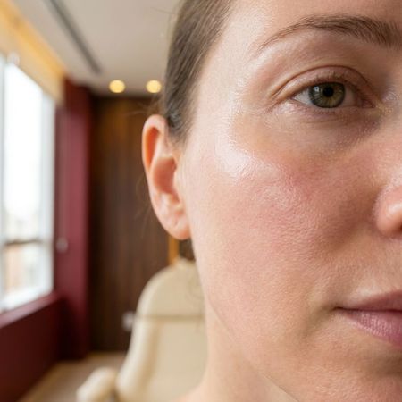 Close-up do rosto de uma pessoa com a pele sem manchas e melasma sob luz quente de ambiente interno
