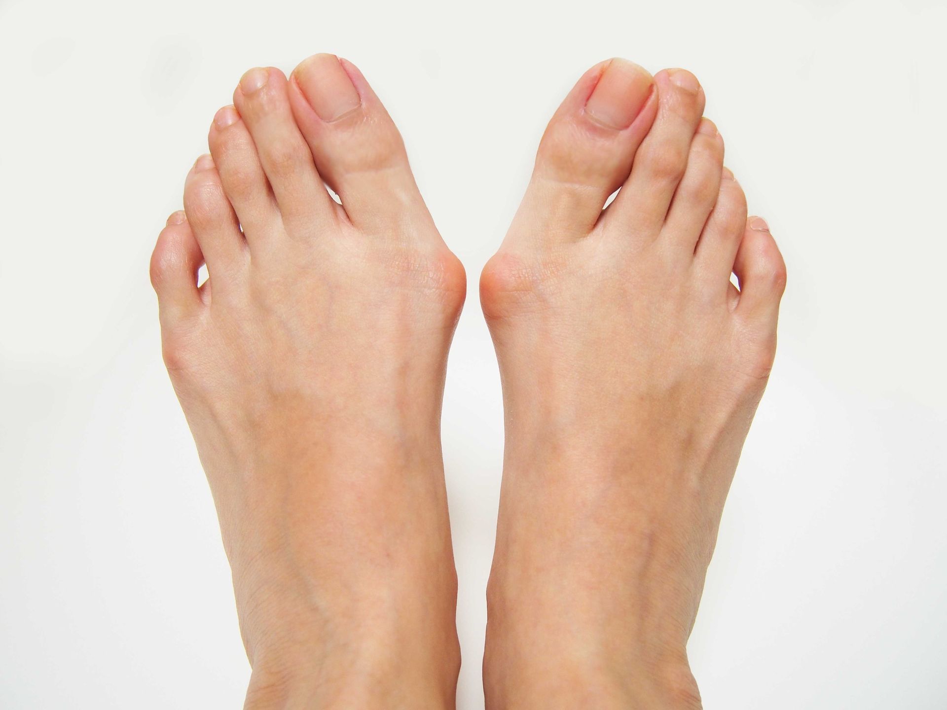 Bunions 