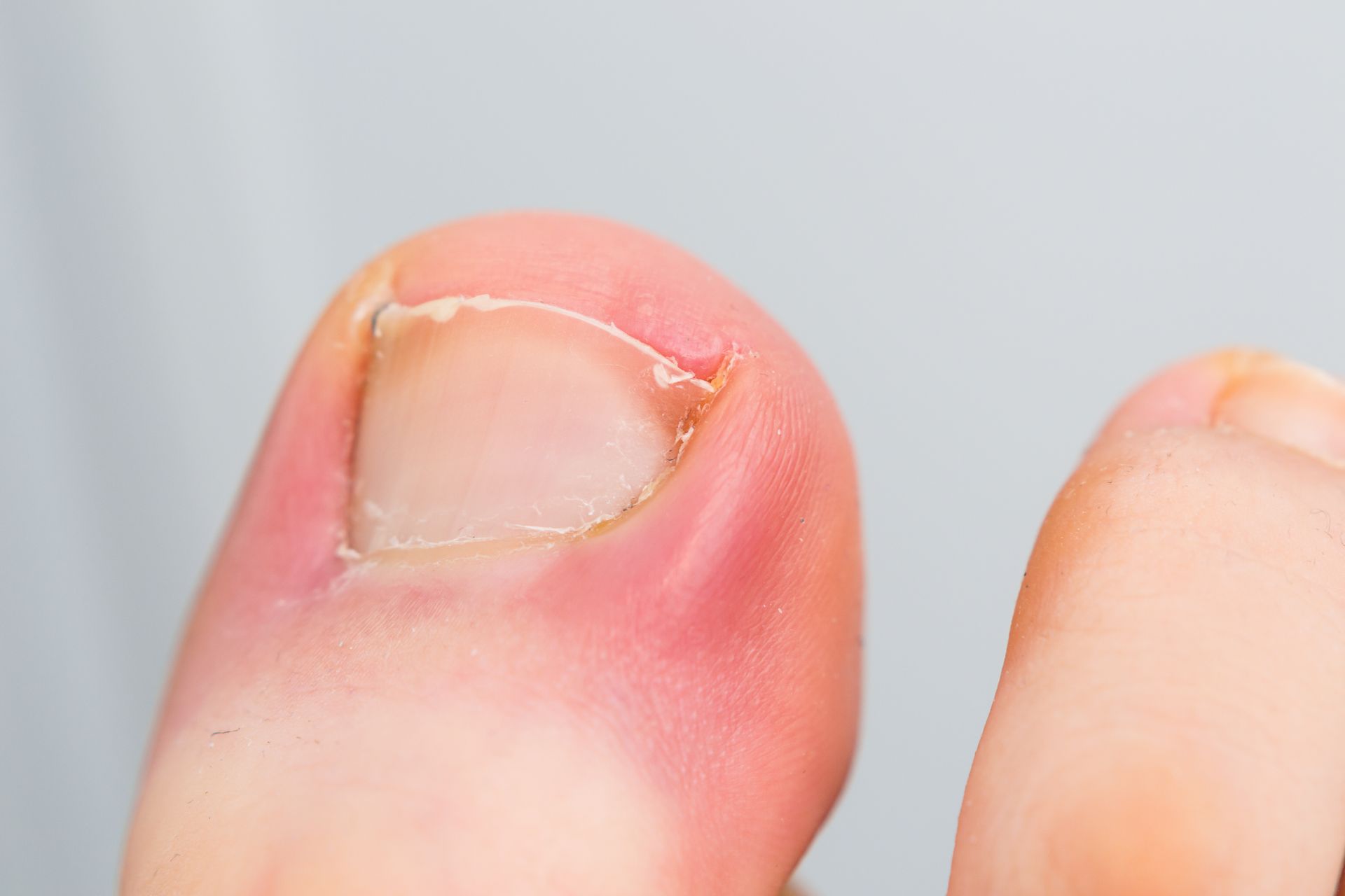 Ingrown Nails 