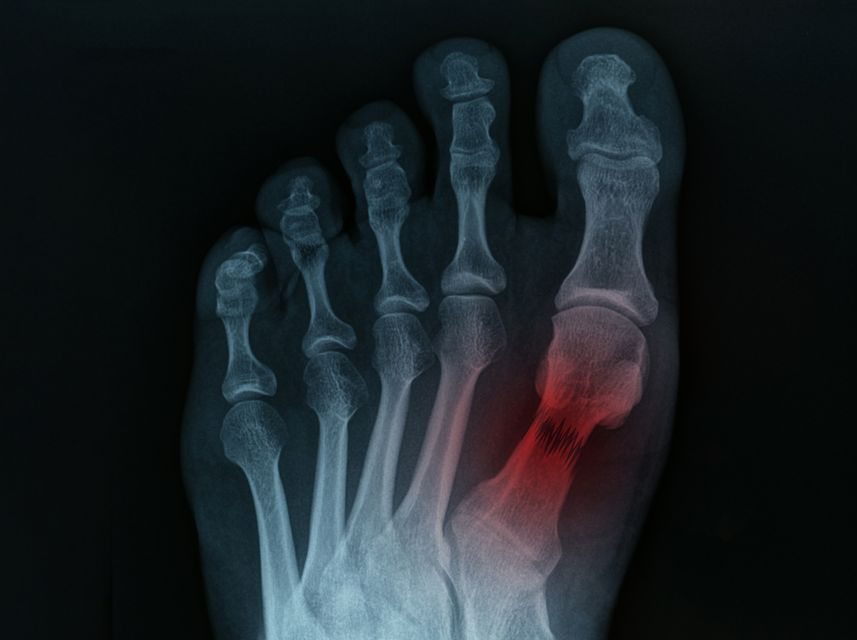 Fractures
