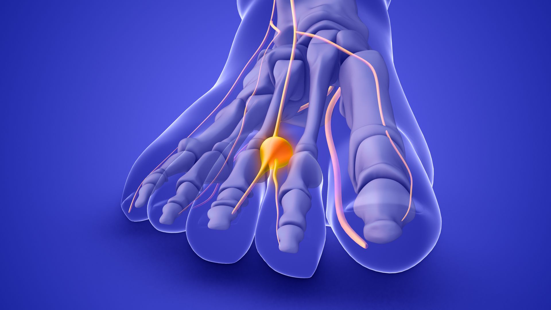 Neuroma