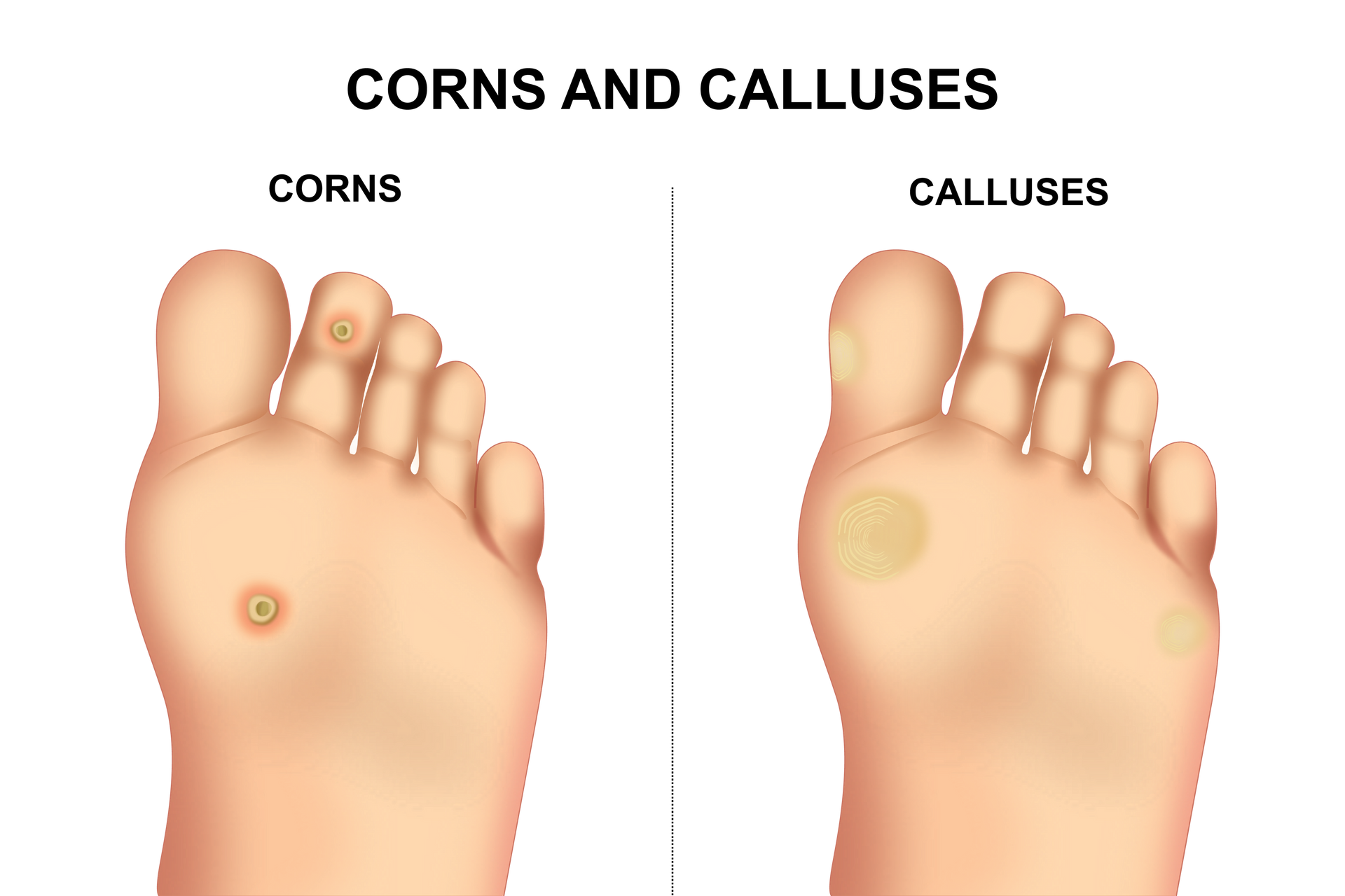 Corns & Calluses 