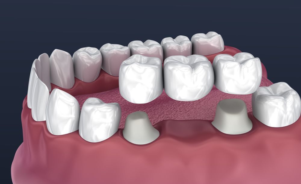 Dental model showing teeth with crowns on some and caps in place for others.