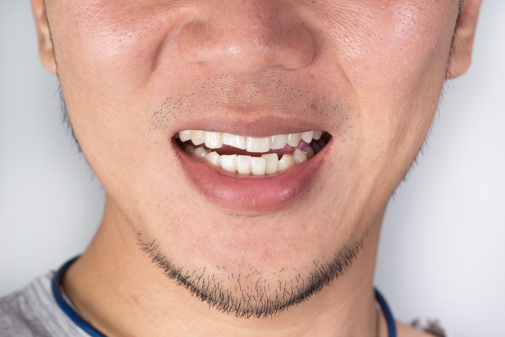 Close-up of a person's mouth, showing an open mouth with a missing front tooth and pained expression.
