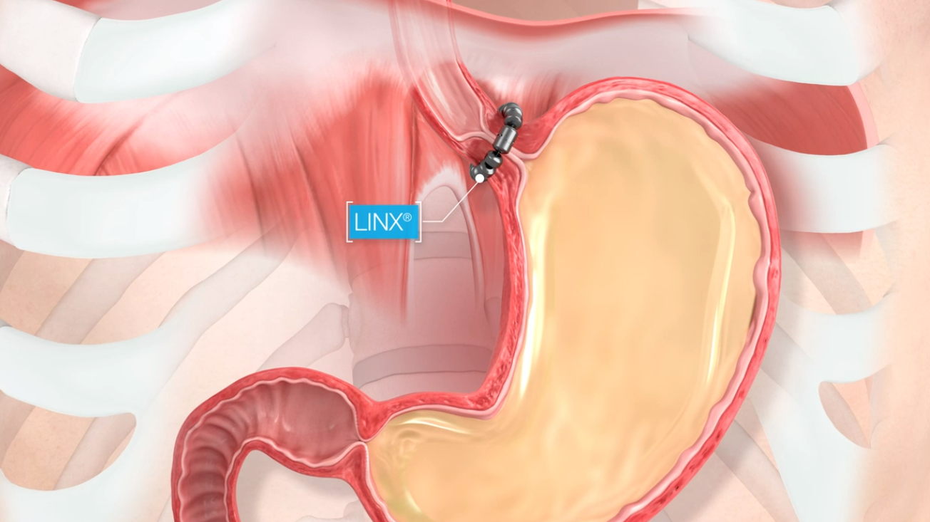 A close up of a person 's stomach with a needle in it.