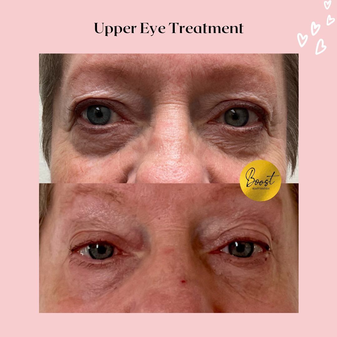 A woman 's eyes before and after upper eye treatment 
