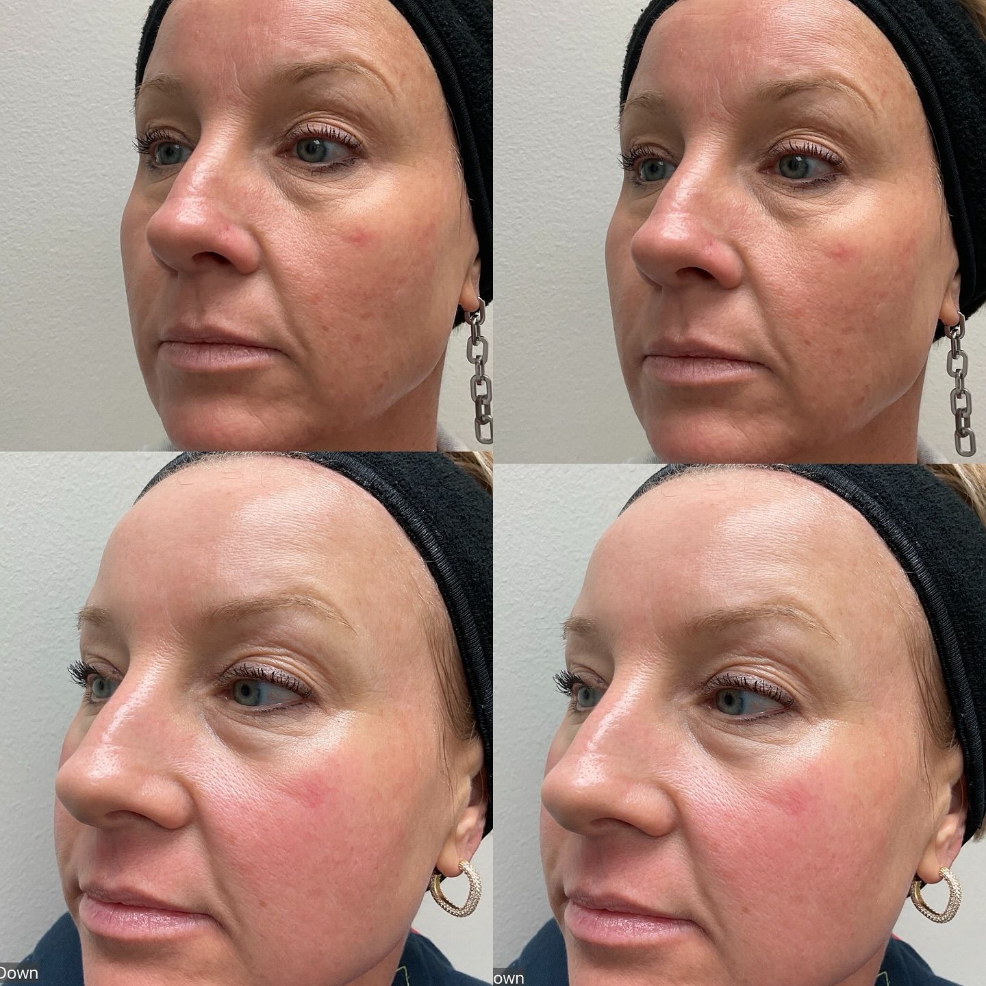 A woman 's face is shown before and after a treatment.