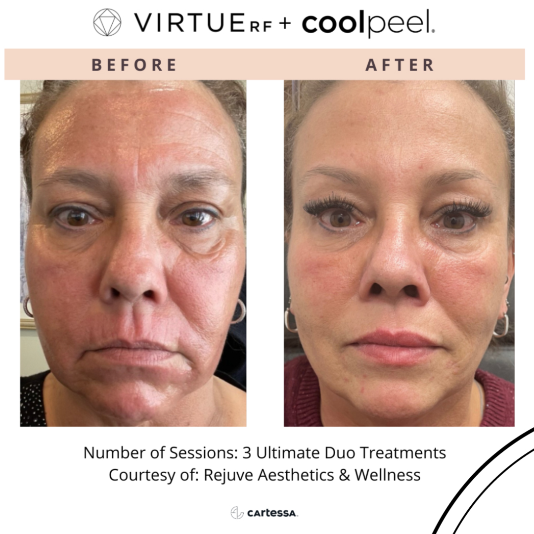 A before and after photo of a woman 's face. 