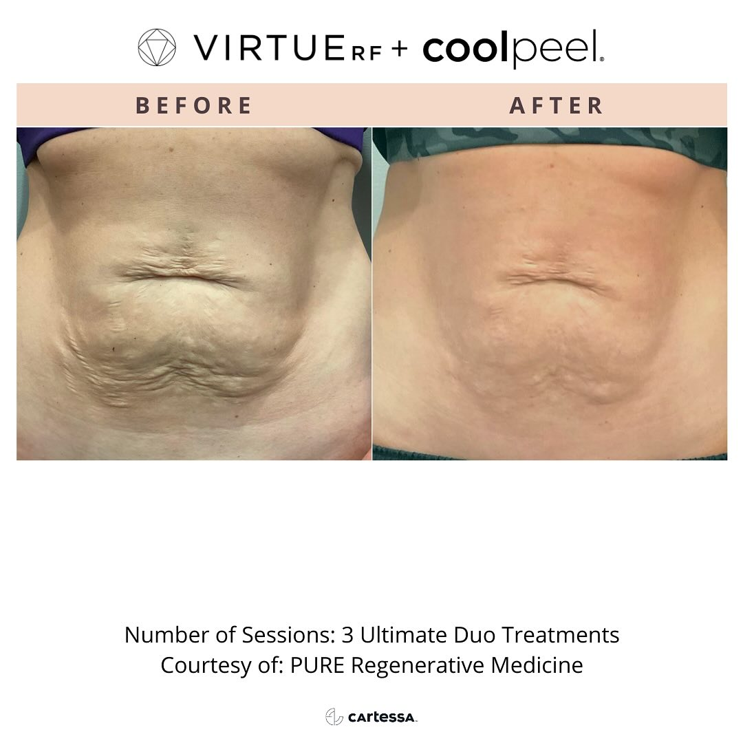 A before and after photo of a woman 's stomach. 