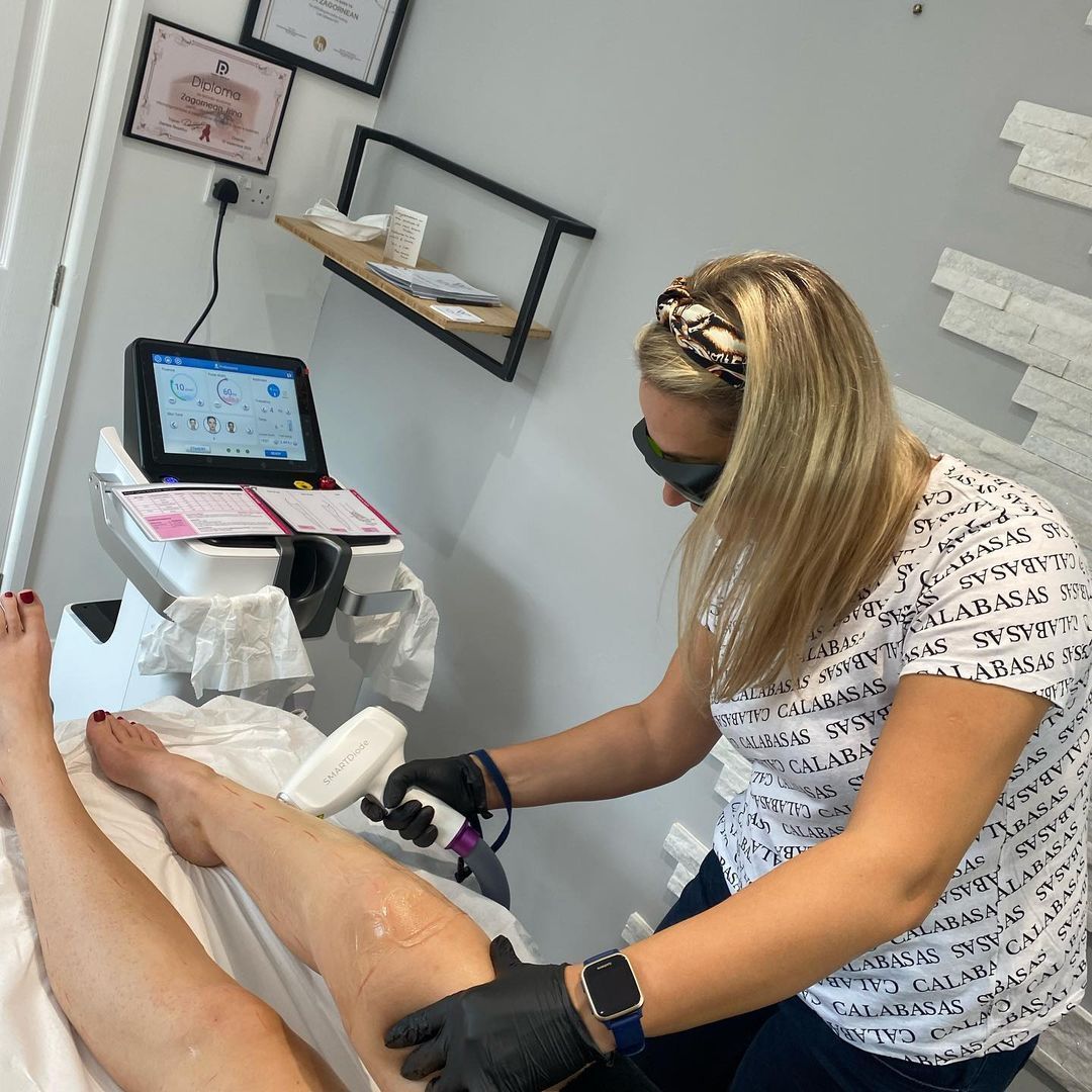 SMARTDiode laser hair removal