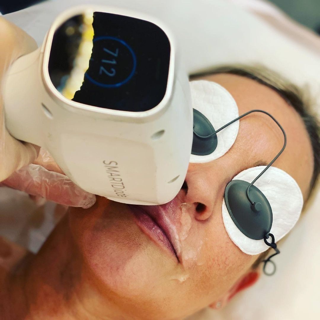 A woman is getting a laser treatment with the number 712 on the screen