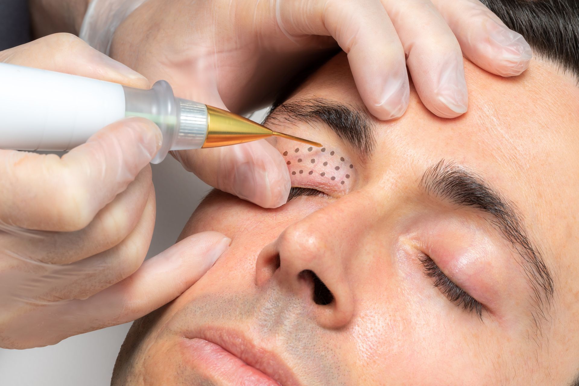 Lifting Without Surgery - The World’s No. 1 Plasma Pen