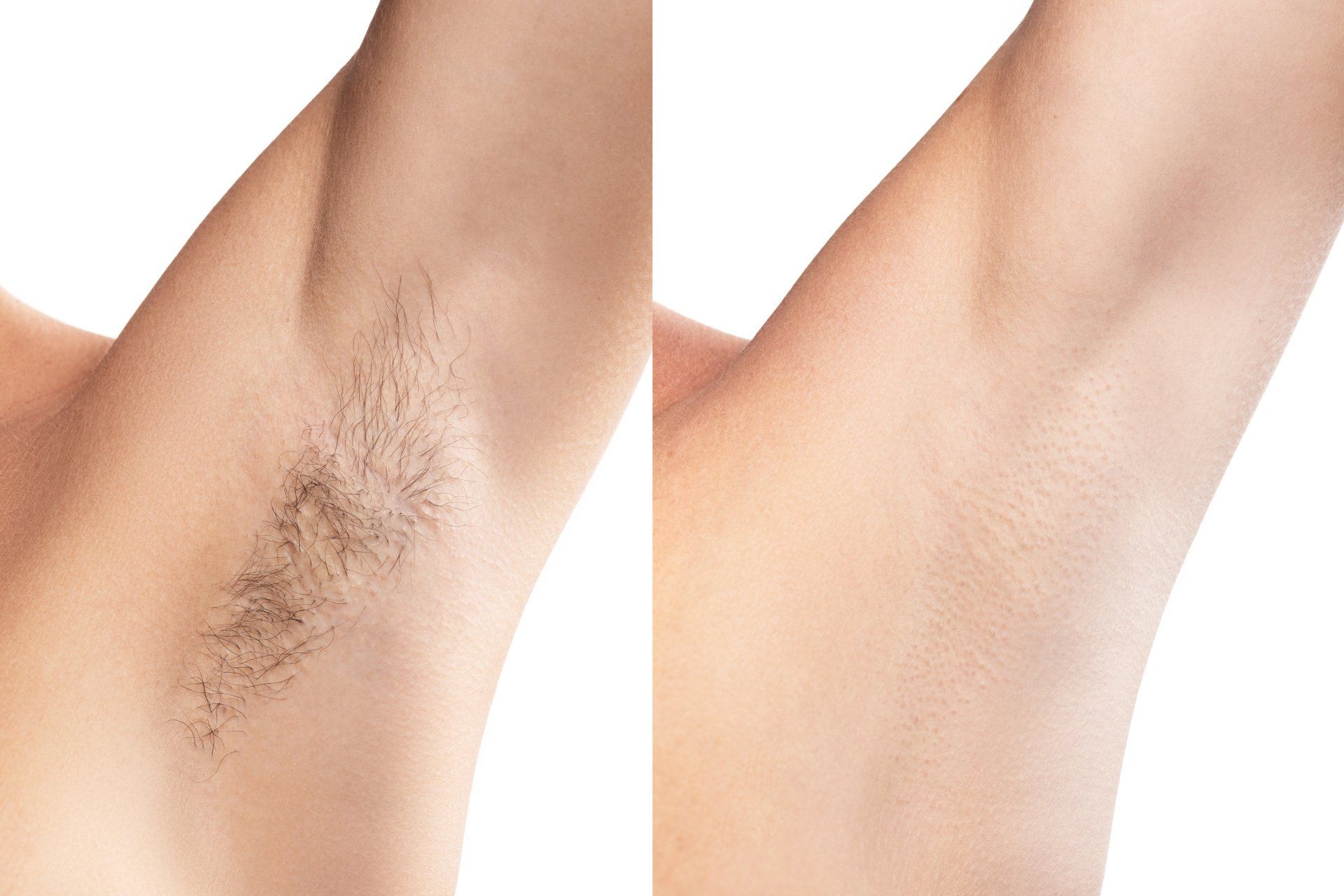 Armpit hair removal before and after