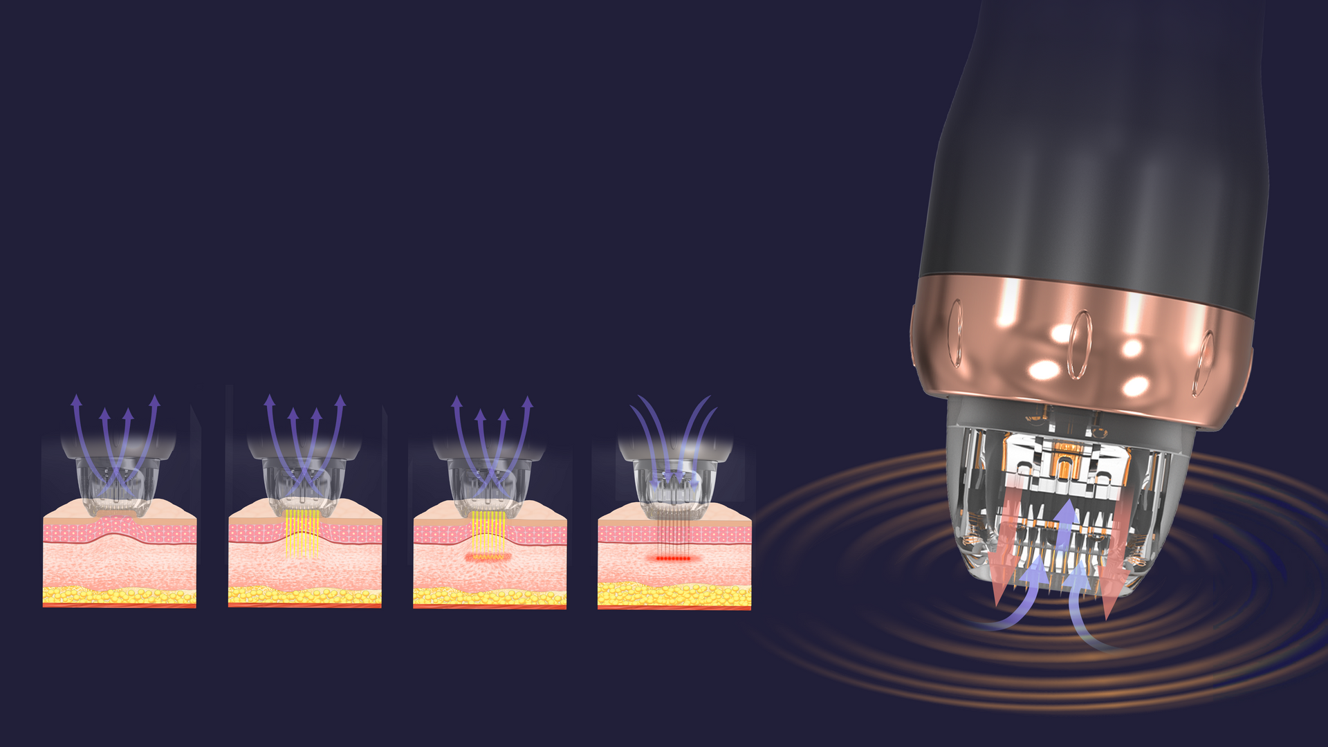 SkinXcell Microneedling + RF