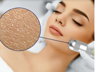 A woman is getting a laser treatment on her face