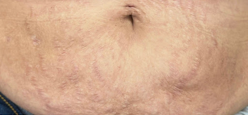 A close up of a person 's stomach with stretch marks.