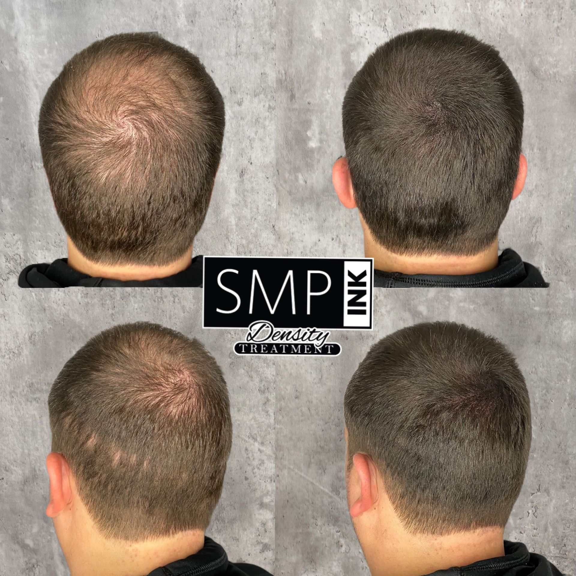 A man before and after receiving SMP from SMP INK
