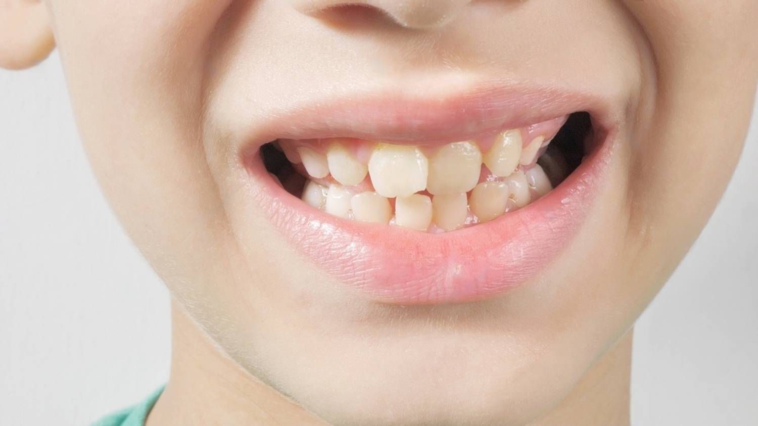 Occlusal Adjustment 380 Family Dentistry