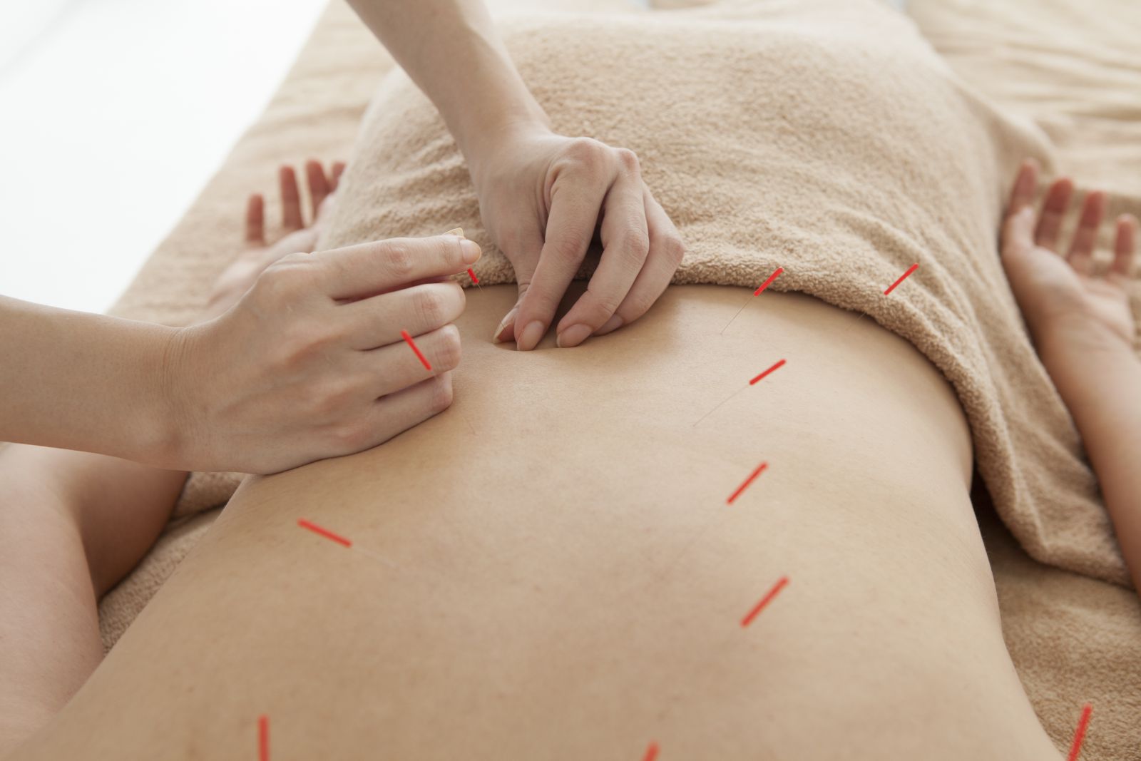 Akupunktur bei chronischen Schmerzen