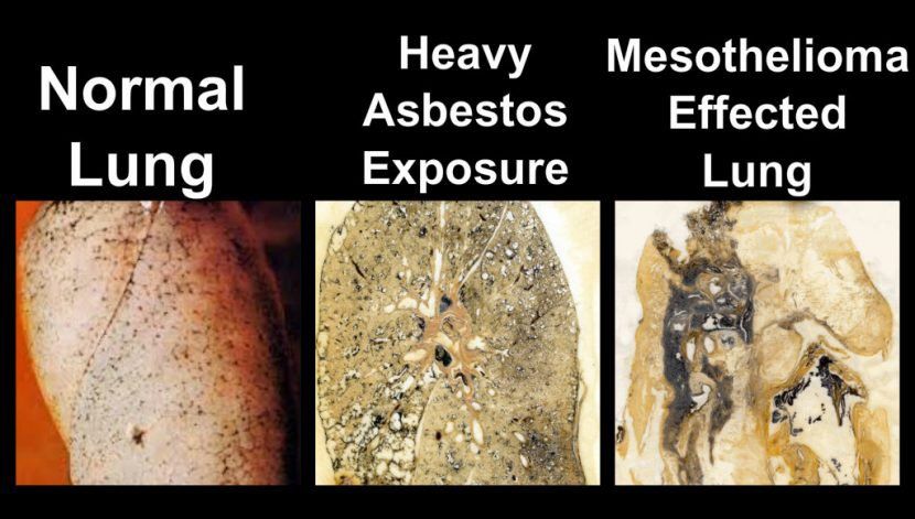 Three lung tissue samples labeled normal, heavy asbestos exposure, and mesothelioma affected lung.