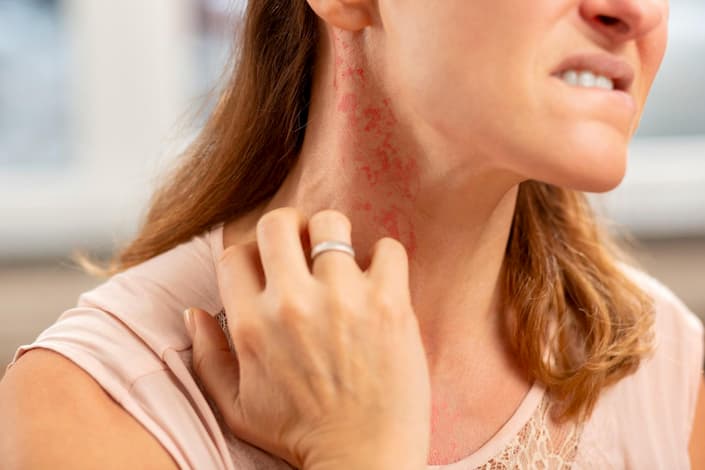 Woman scratching an itchy red rash on her neck with her hand