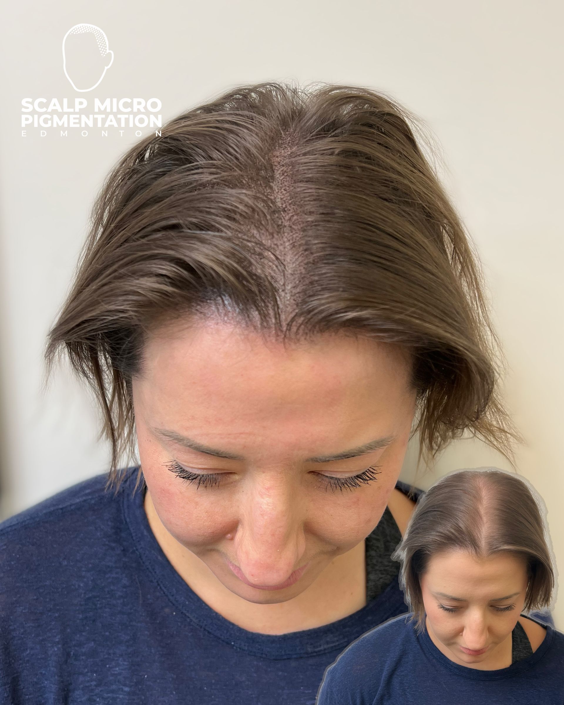 Scalp Micropigmentation Treatments SMP Edmonton