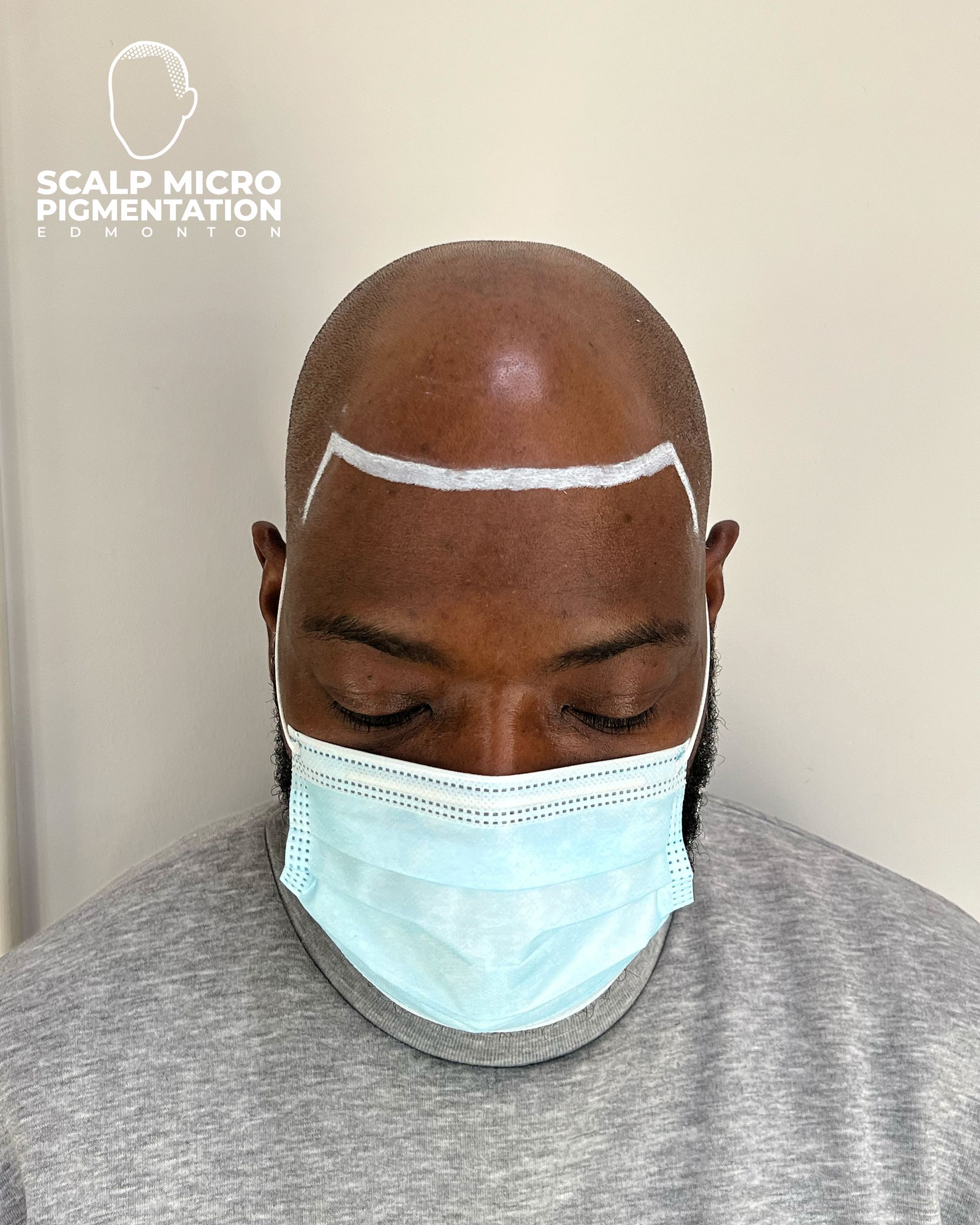 Male Client M72 | Scalp Micropigmentation | Edmonton