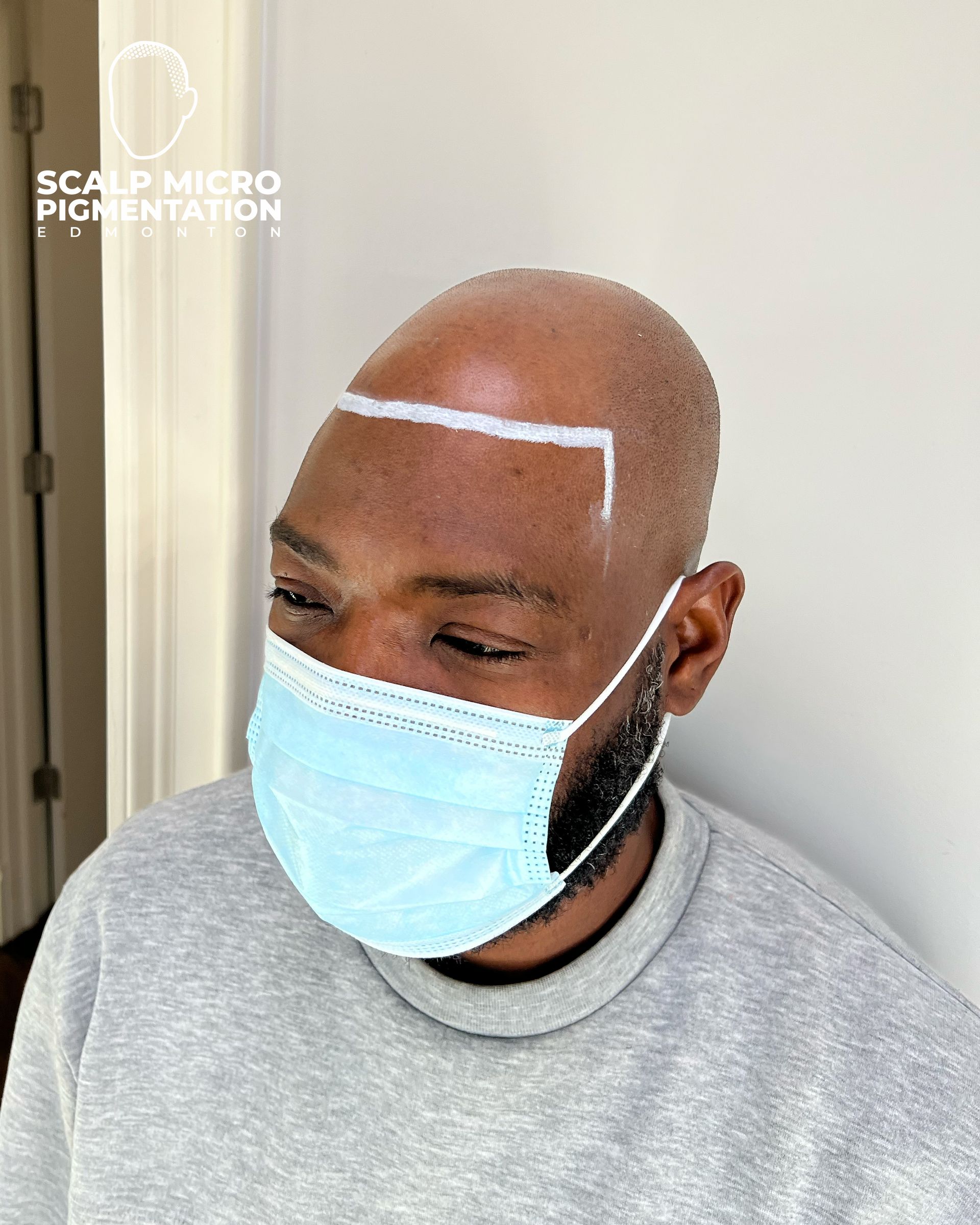 Male Client M72 | Scalp Micropigmentation | Edmonton