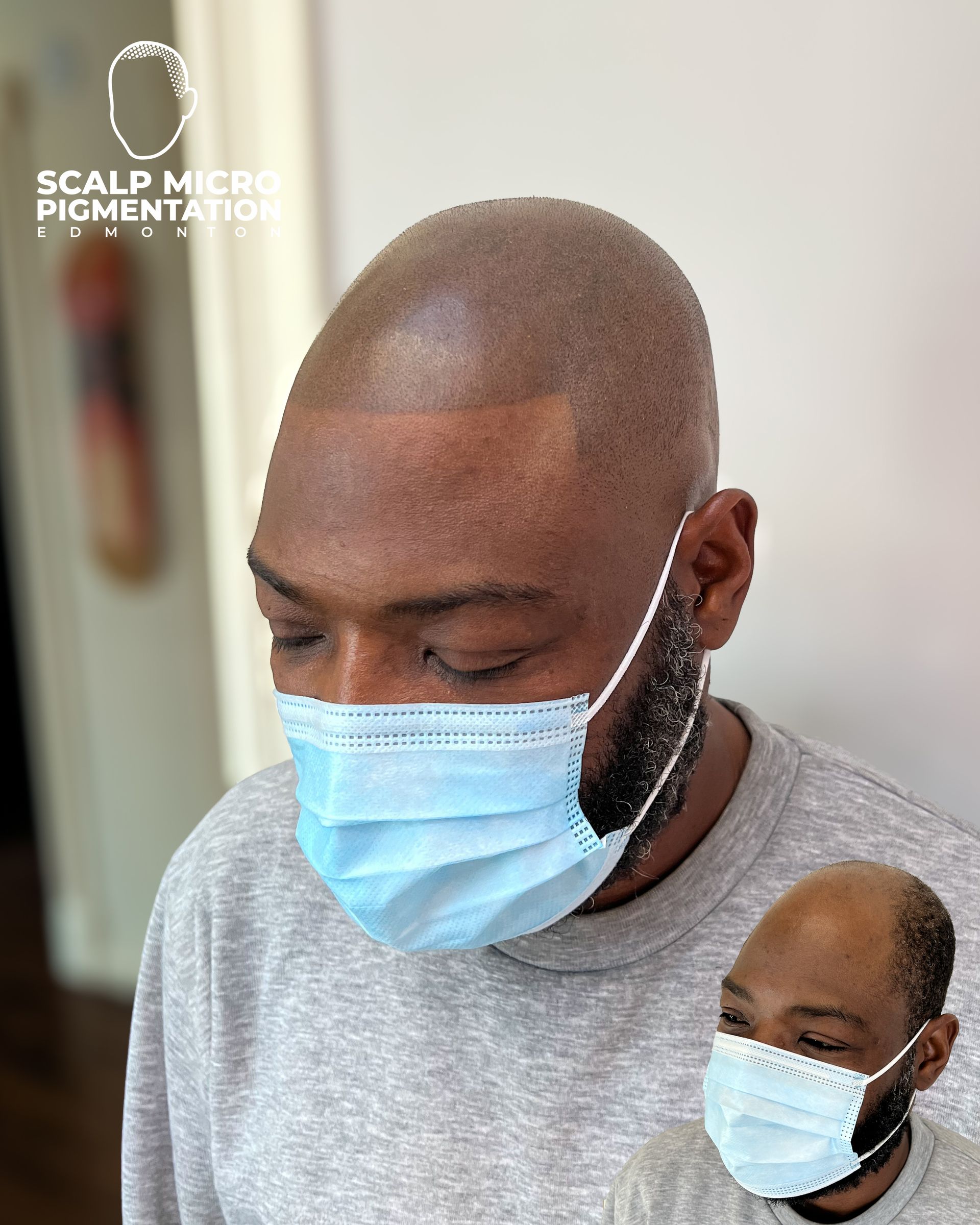 Male Client M72 | Scalp Micropigmentation | Edmonton