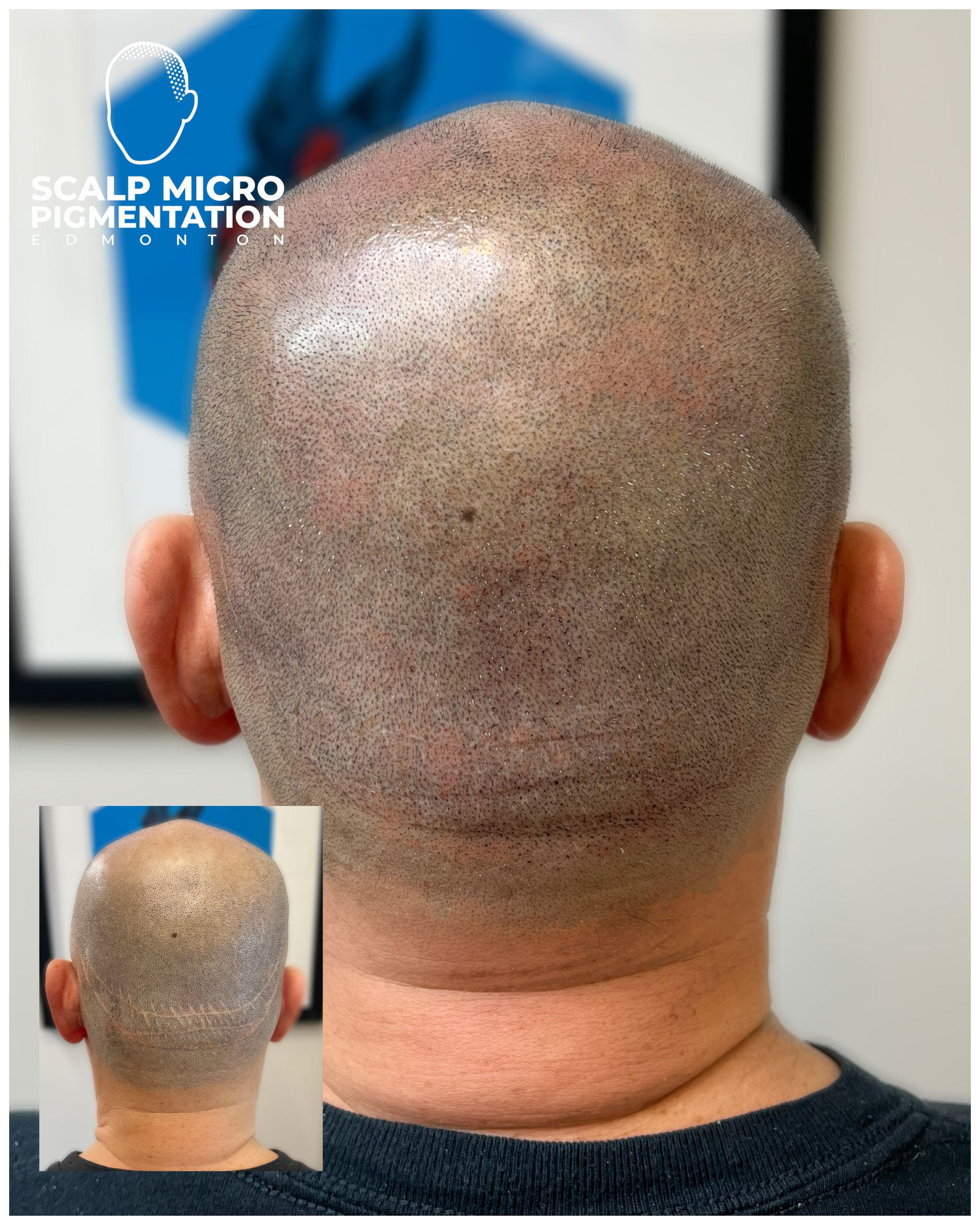 Scalp Micropigmentation Treatments SMP Edmonton